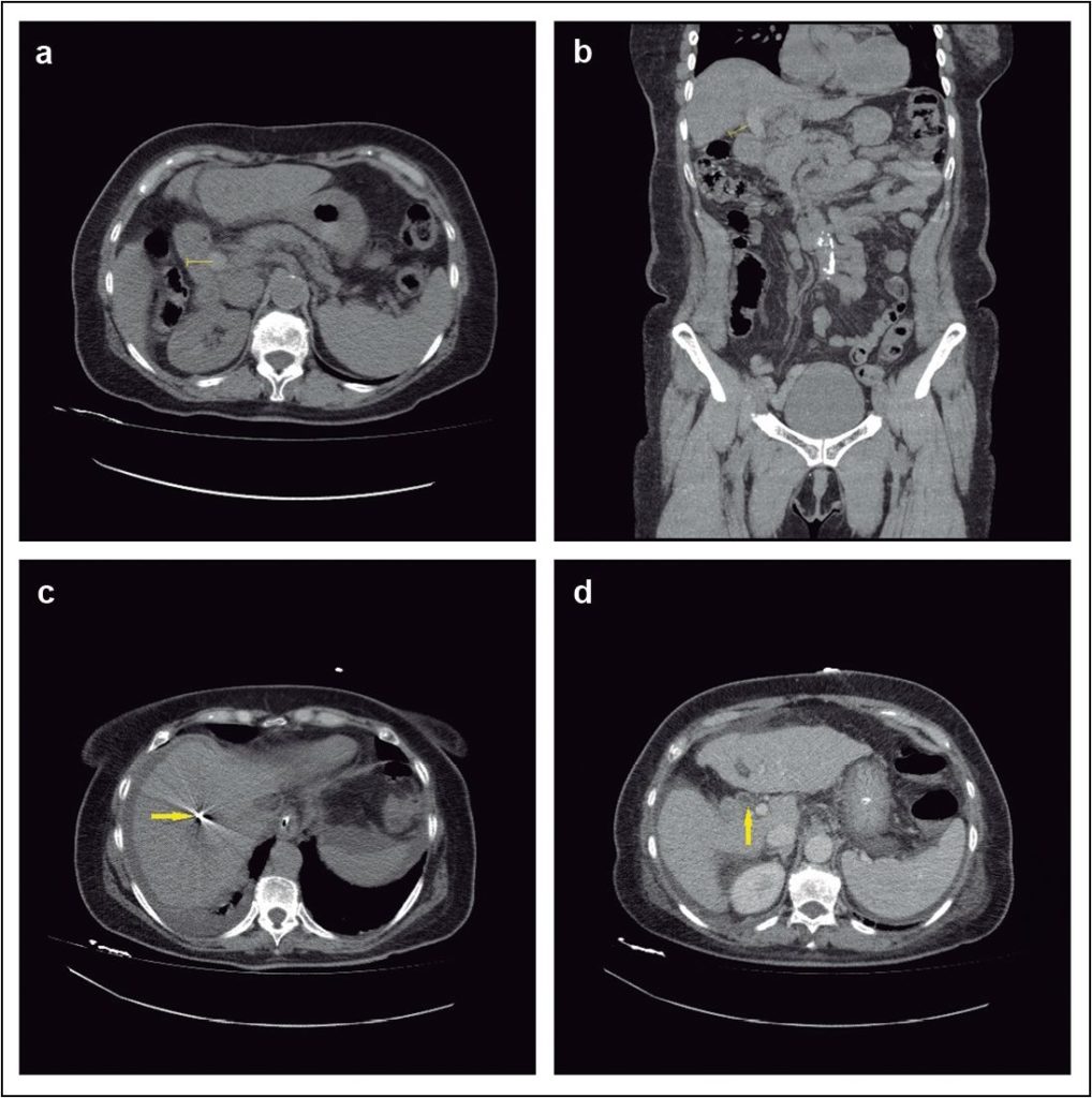 Necrosectomía endoscópica asistida por laparoscopia: un enfoque ...